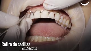 ¿Dañarán mis dientes en el retiro de carillas en resina [upl. by Vito]