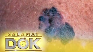 Salamat Dok Melanoma and cancerous moles [upl. by Robinetta]