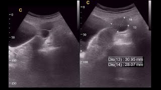 Septated cyst  Broad cervix  Ultrasonography report  Amader hospital  আমাদের হাসপাতাল [upl. by Procto]