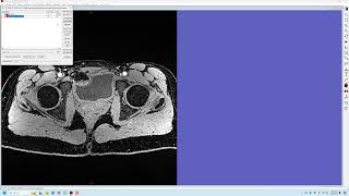 MRI Hip Atlas construction [upl. by Mariejeanne324]