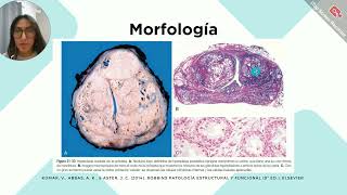 HPB y Adenocarcinoma prostáticoMadariaga Villanueva Elizabeth [upl. by Noxid]