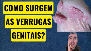 Como surgem as verrugas genitais [upl. by Ariayek]