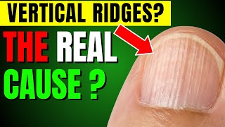 The Shocking Reasons Behind Vertical Nail Lines [upl. by Moseley819]