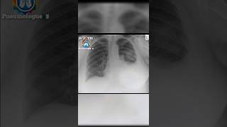 Radiographie thoracique chest xray radiologiest radiographie [upl. by Dolf]