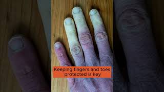 Would you recognise Raynauds Syndrome symptoms [upl. by Suedaht]