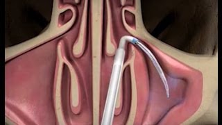 Balloon Sinuplasty Procedure with ENT Dr Timothy Ragsdale [upl. by Debbra]