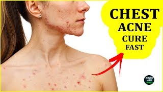 How To Get Rid of Chest Acne OVERNIGHT – Remove Body Acne Naturally [upl. by Dustie]