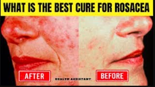 Rosacea Treatment For Face What Is The Best Cure For Rosacea  Rosacea Treatment To Reduce Redness [upl. by Anatniuq]