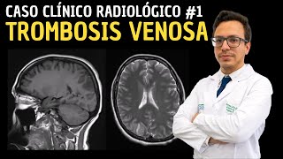 Caso Clínico Radiológico 1 Trombosis Venosa [upl. by Nujra]