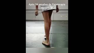 Pé Caído Tratamento de Fisioterapia Neuropatias compressivas Membro inferior fibular nerve injury [upl. by Ianteen]