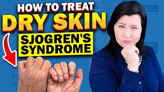 Skin Dryness in Sjogrens Syndrome Patients Treatment Options [upl. by Abisha]