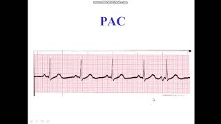 Premature Atrial Complex  Bigeminy  Trigeminy [upl. by Corder]