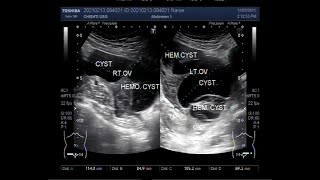 Bilateral Multiple Ovarian Cysts and Ovarian Mass [upl. by Cristi]