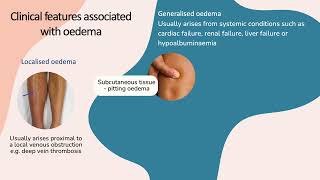 Clinical presentation of oedema [upl. by Miner]