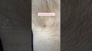 Skin Tag Removal before and after results skintagremoval [upl. by Dimitris]