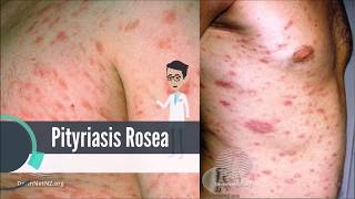 What is Pityriasis Rosea [upl. by Tilden]