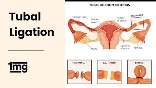 Tubal Ligation Dr Astha Dayal Gynaecologist  1mg [upl. by Ko]