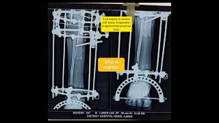 ilizarov surgery bone transport radiological progress [upl. by Ecirad142]