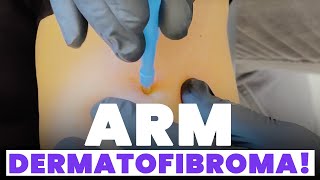 ARM DERMATOFIBROMA [upl. by Winonah373]