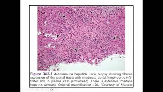 Pediatric Hepatology Cases  Discussion [upl. by Jet]