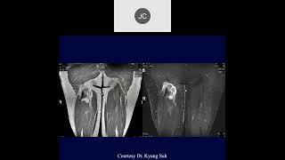 MRI of the Hip Part 5 – Hip Trauma [upl. by Jereme]