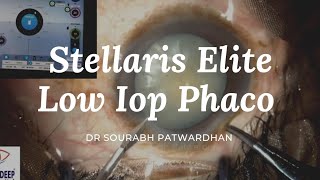 Stellaris Elite Sourabh Patwardhan Live Phaco surgery For training and consultation call 9220001000 [upl. by Jessamine]