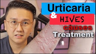 URTICARIA amp HIVES  Causes and Treatment of Itchy Skin Rash [upl. by Manas]