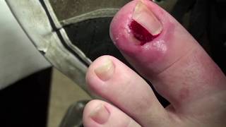 Santa Barbara Podiatrist foot doctor talks about Ingrown Toenails [upl. by Llemmart]