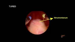 Transurethral Resection of Ejaculatory Ducts a Step by Step Guide [upl. by Maryanne]