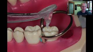 Class II Fillings  Tips amp Tricks [upl. by Amathiste]