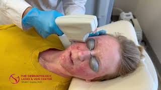 Levulan Photodynamic Therapy for Acne with Blue Light and Laser  Dr Shalini Gupta [upl. by Shela355]