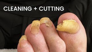 Toenail Cleaning Removal  Elderly Pedicure [upl. by Axe]