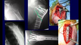 Proximal Humerus Fractures 2 OTA lecture series III u03b [upl. by Schlicher]