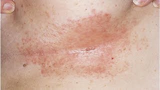 Natural Remedies for Intertrigo Candida of the Skin Folds [upl. by Nereus500]