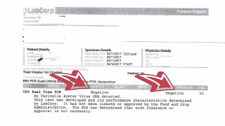 Varicella Zoster Virus Shingles NEGATIVE PCR Test Following Scalar Light Sessions [upl. by Arlene]