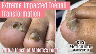 👣How to Pedicure on Extreme Impacted Toenail with Major Transformation 👣 [upl. by Christi583]