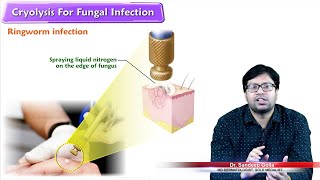 Cryotherapy for Fungal infection  Dr Sandeep Golla MD Dermatology [upl. by Ikik]