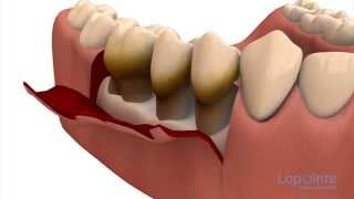 Parodontie par lambeaux  Centres dentaires Lapointe [upl. by Atekram220]