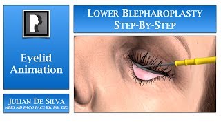 Blepharoplasty Animation – How is Lower Blepharoplasty Eyelid Surgery completed [upl. by Rheingold]