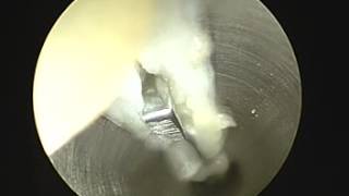 Endoscopic Plantar Fasciotomy SFISM [upl. by Hull869]