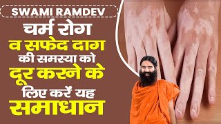 चर्म रोग Skin Disease व सफेद दाग की समस्या को दूर करने के लिए करें यह समाधान  Swami Ramdev [upl. by Schulze]