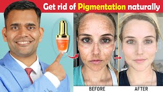 How To Get Rid Of Hyperpigmentation  Ageing or Dark Spots  Naturally Get Rid Of Hyperpigmentation [upl. by Sebbie]