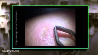 Morgellons Presentation Potent News Blast 10 [upl. by Gudren]