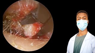 Unbelievable bloody Ear Wax Removal Compilation Must Watchear earwaxremovalearwaxcleaningrelax [upl. by Narok888]