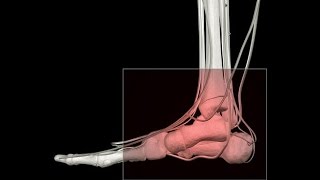 Can ozone heal an ankle Prolozone for chronic Ankle pain from arthritis [upl. by Notlimah]