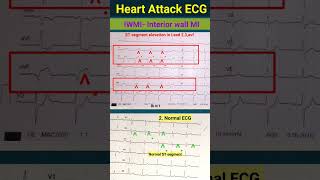 Ecg से हार्ट अटैक का पता कैसे चलता हैं l IWMI l ecg echo shorts [upl. by Asylla188]