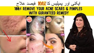 100 REMOVE ACNE SCARS PIMPLES ACNE WITH GUARANTEED TREATMENT IN URDU  HINDI BY DR BILQUIS SHAIKH [upl. by Etac]