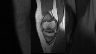 Osteochondritis dissecans of the knee [upl. by Anavoj]