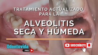 Tratamiento Actualizado para la Alveolitis Seca y Húmeda Limpieza Medicación y Apósitos [upl. by Zanas]