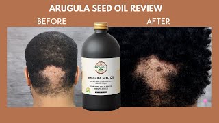 ARUGULA SEED OIL 8 MONTH REVIEW  COULD IT REGROW HAIR ON A BALD SPOT  BEFORE AND AFTER RESULTS [upl. by Anahtor]